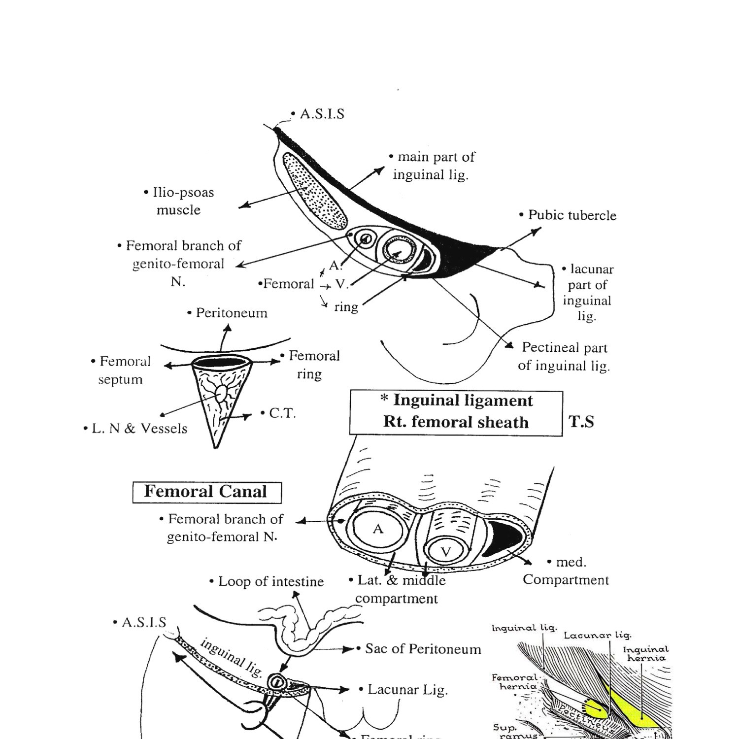 FEMORAL HERNIA.doc | DocDroid