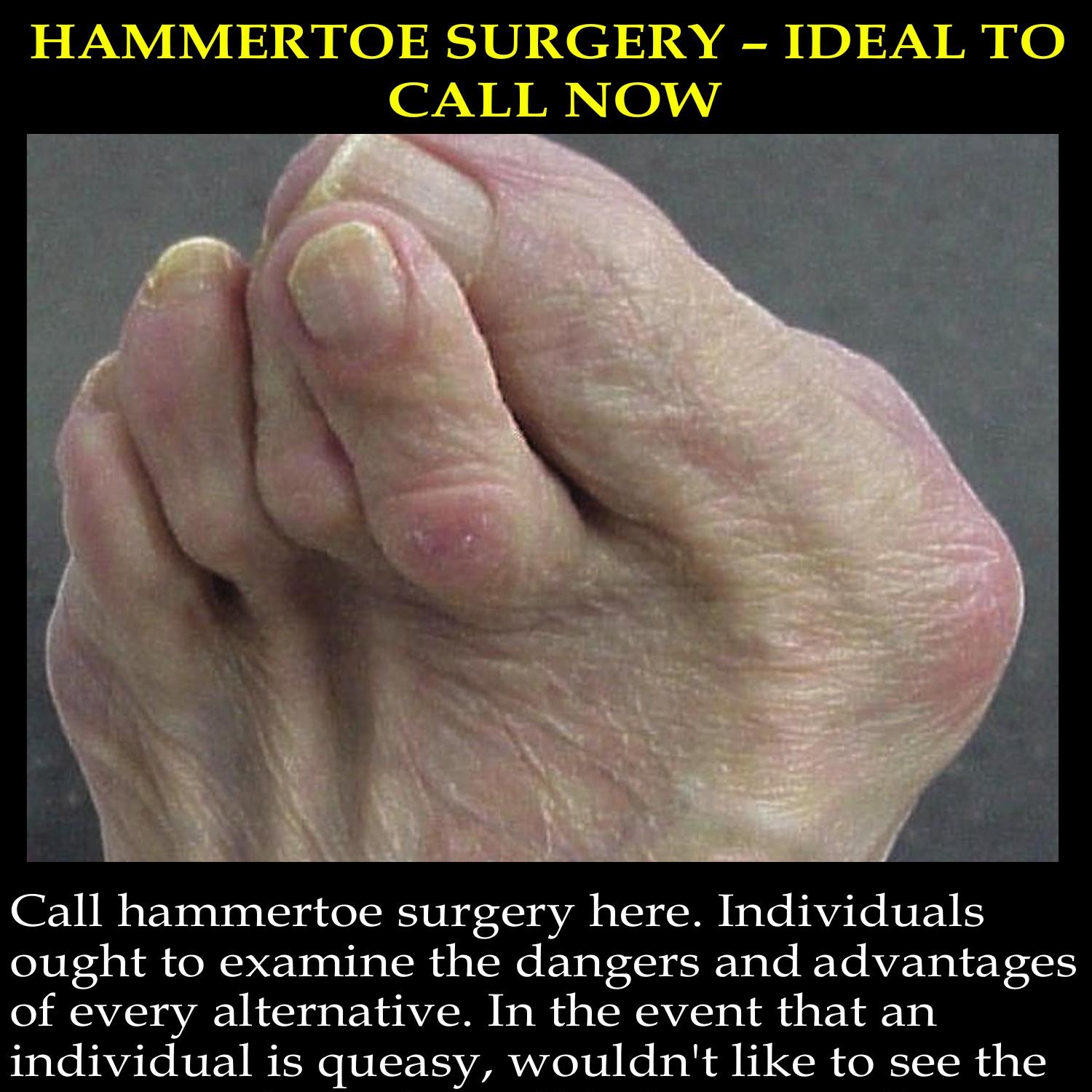 Hammertoe Surgery Ideal To Call Now Docx DocDroid   Hammertoe Surgery Ideal To Call Now Docx 