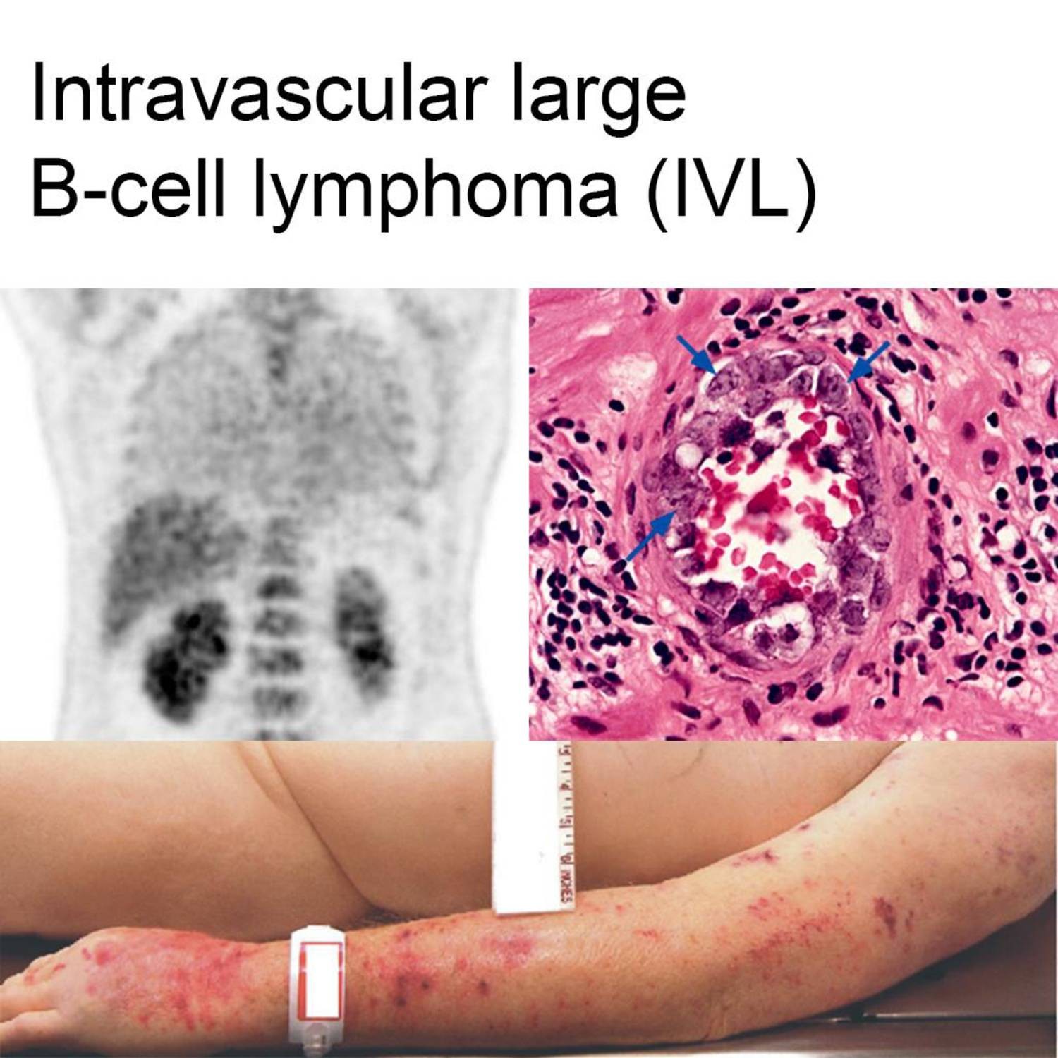 Intravascular Large B-cell Lymphoma.pdf | DocDroid